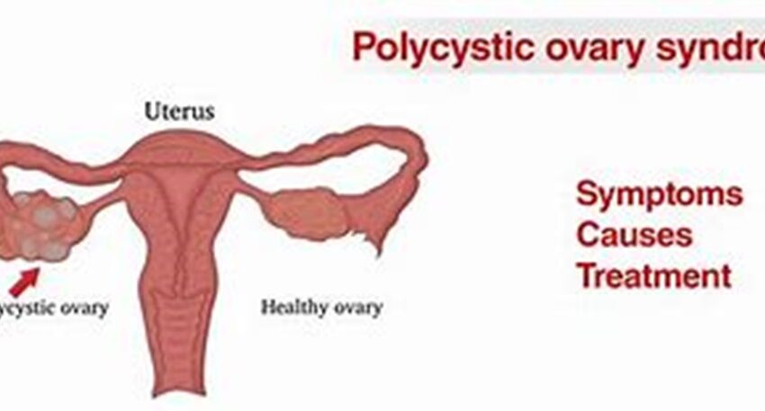 Polycystic Ovarian Syndrome